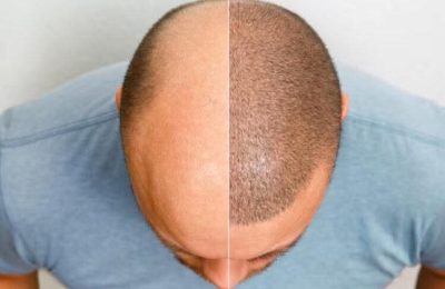 Revolucion kundër tullacëve? Shkencëtarët zhvillojnë një xhel që stimulon rritjen e flokëve